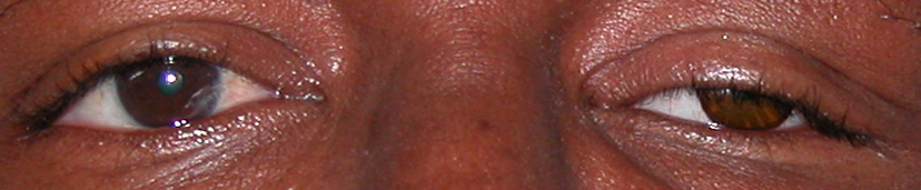 prothese oculaire 8 peau noire