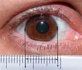 Mesure diamètre iris prothese oculaire