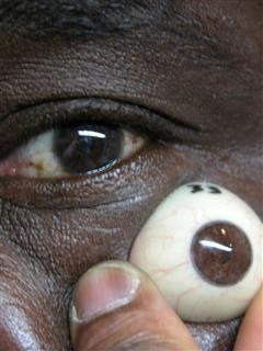 Sclérotique peau noire oculariste