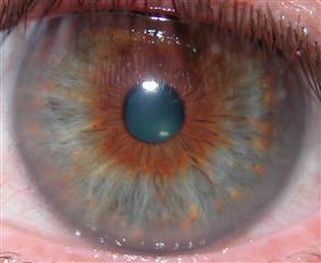 Iris oculariste auréole 