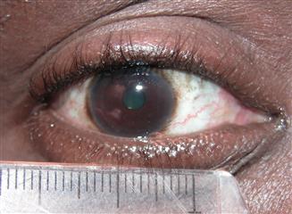 Mesure iris prothèse oculaire sur peau noire.