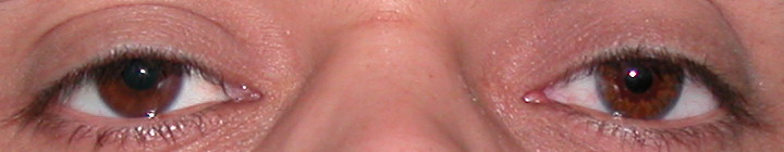 prothese oculaire b