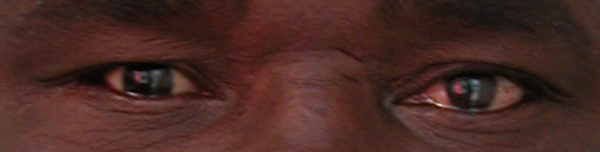 prothese oculaire c