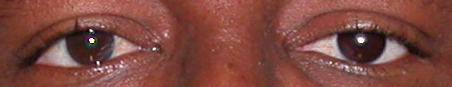prothese oculaire e