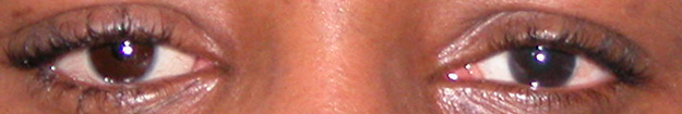 prothese oculaire f