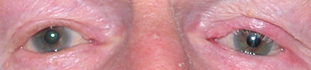 prothese oculaire g