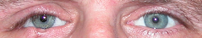 prothese oculaire a