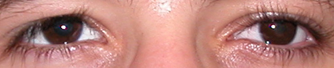 prothese oculaire h