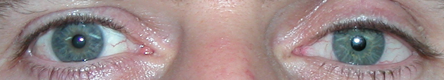 prothese oculaire i