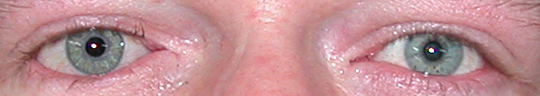 prothese oculaire j
