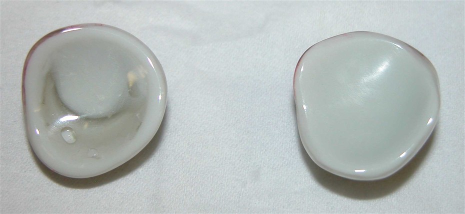 prothèse oculaire double coque