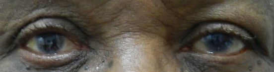 prothese oculaire k