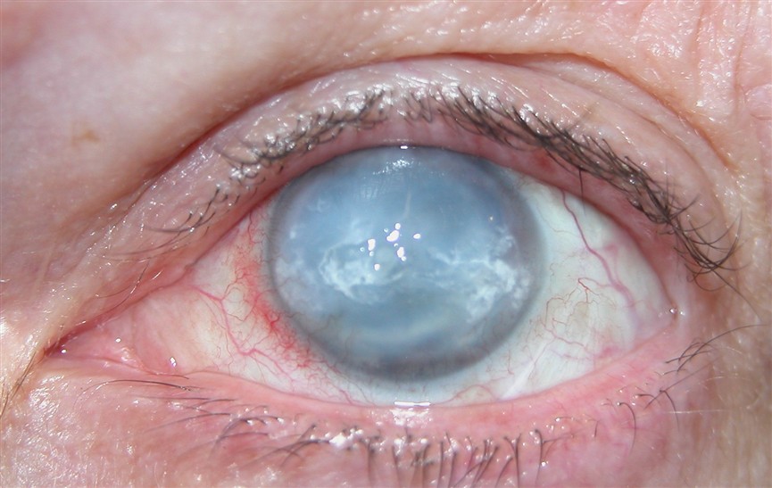 Oeil en phtyse