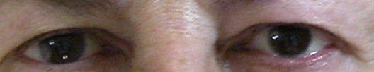 prothese oculaire l