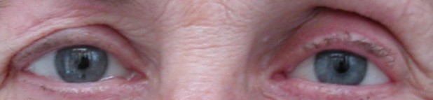 prothese oculaire n
