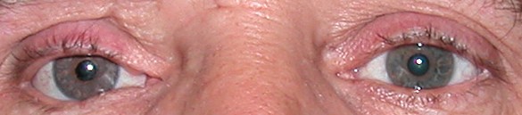 prothese oculaire o