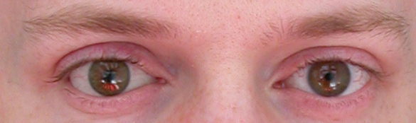 prothese oculaire p