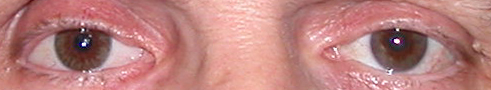 prothese oculaire r