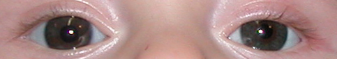 prothese oculaire s