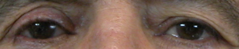 prothese oculaire u