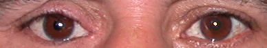 prothese oculaire v