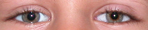 prothese oculaire w