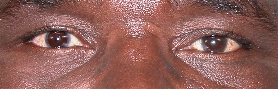 prothese oculaire x