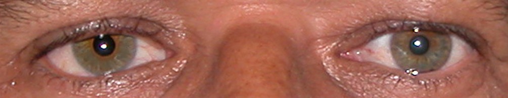 prothese oculaire z