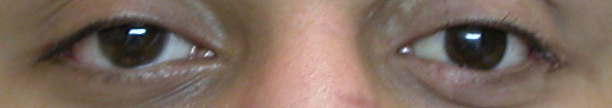 prothese oculaire 26