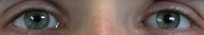 prothese oculaire 27