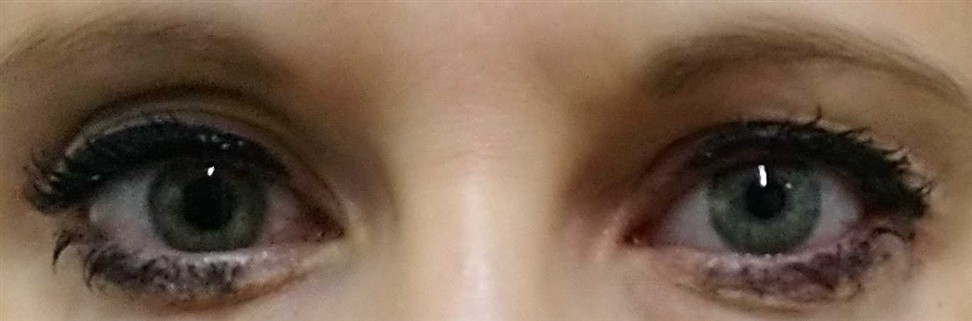 Prothèse oculaire provisoire gauche