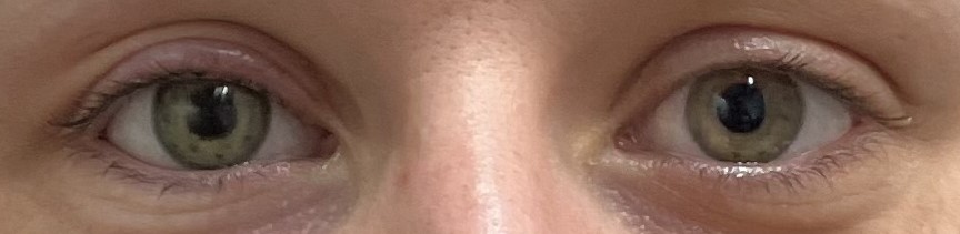 Prothèse oculaire provisoire OD