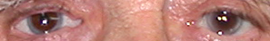 prothese oculaire 28